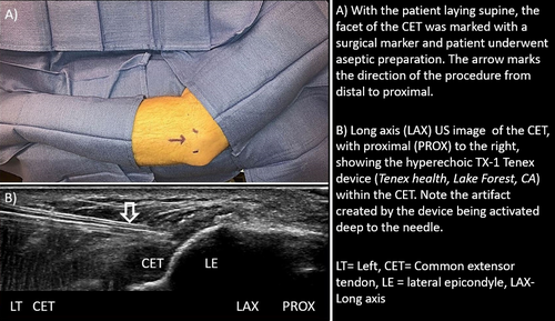 A diagram showing the Tenex procedure in action, with ultrasound waves targeting and destroying unwanted tissue